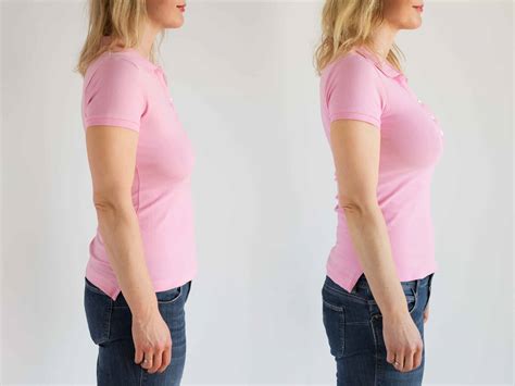 Vampire Breast Lift: Before and Afters, How it Works and More